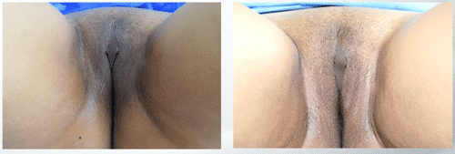 Before-after-initimate-whitening
