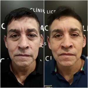 Before and after of a blepharoplasty