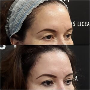 Before and after of an eyelift