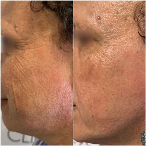 Chemical Peel before and after