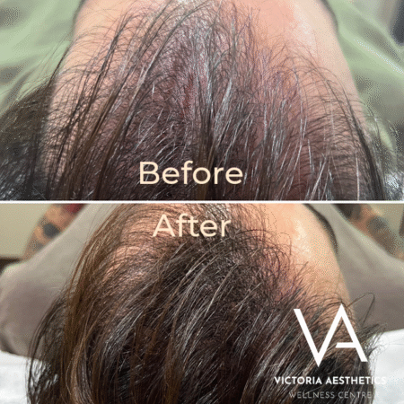 Hair restoration session at the clinic