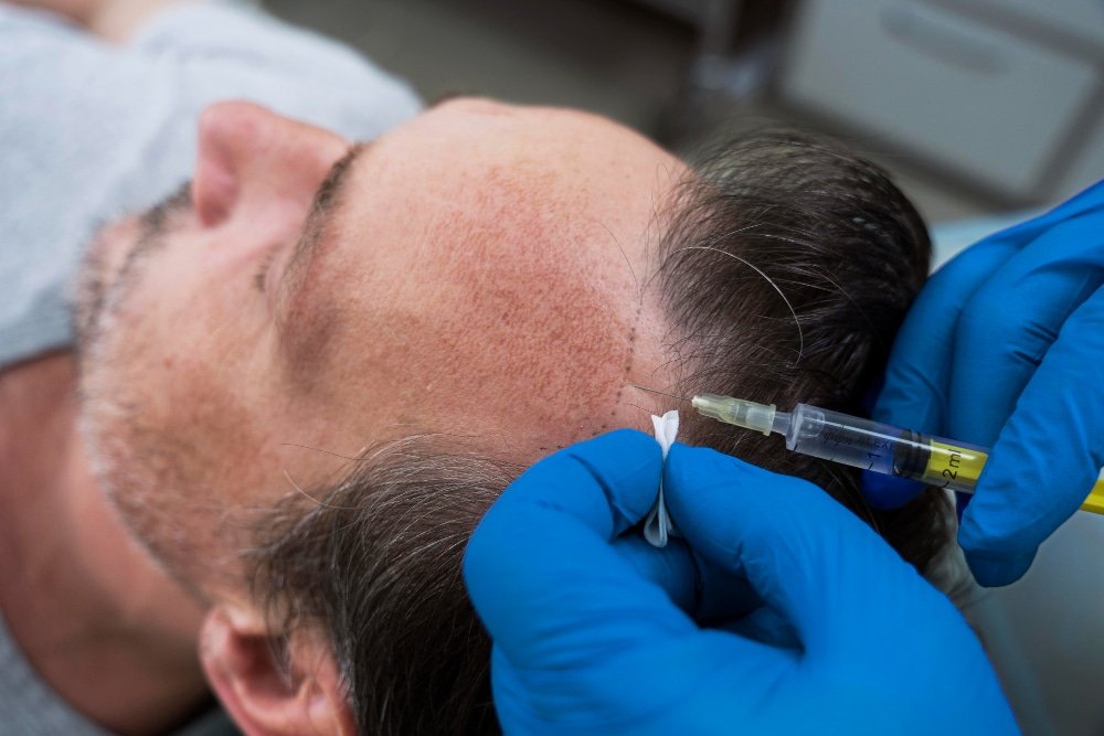 hair loss treatment in Seychelles