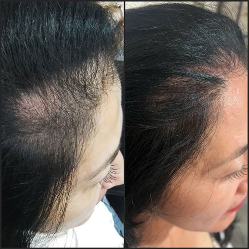 Before and After Hair Mesotherapy and Dermapen in Seychelles