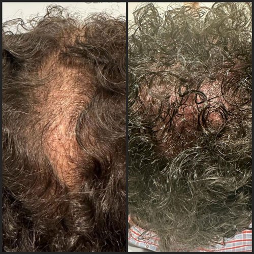 Before and After Hair Mesotherapy and Dermapen in Seychelles