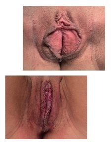 Labia minora reduction